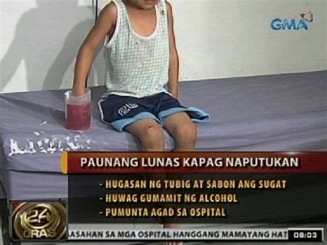 what to do pag nasabugan ng paputok ang kamay
